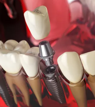 Dental Implants